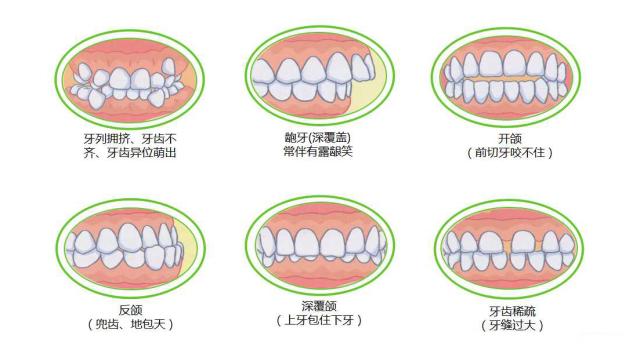 深圳箍牙-深圳牙齿矫正-深圳牙齿矫正适应症-维港口腔连锁-维港欢笑口腔