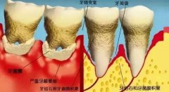 【深圳牙周治療】什麼因素會導致牙周病的發生呢？