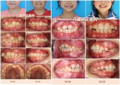 【深圳兒童矯正】兒童牙齒畸形為什麼要儘早進行牙齒矯正呢？