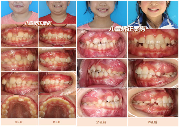 深圳儿童牙齿矫正-深圳儿童牙齿矫正案例-维港口腔连锁-维港欢笑口腔
