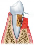 【深圳牙齒矯正】有牙周病還可以進行牙齒矯正嗎？