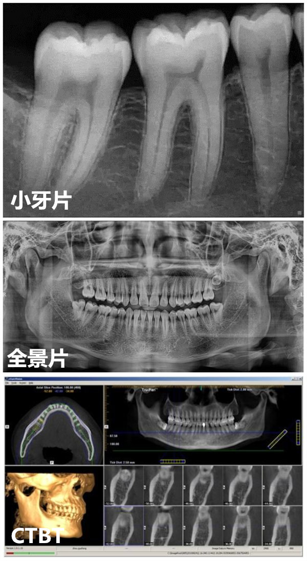 牙片-全景片-小牙片-CT-深圳牙科-维港口腔连锁-维港欢笑口腔