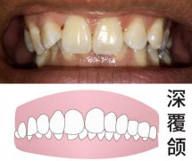 深圳牙齒矯正科普-上排牙齒完全蓋住下排牙齒是正常的嗎？