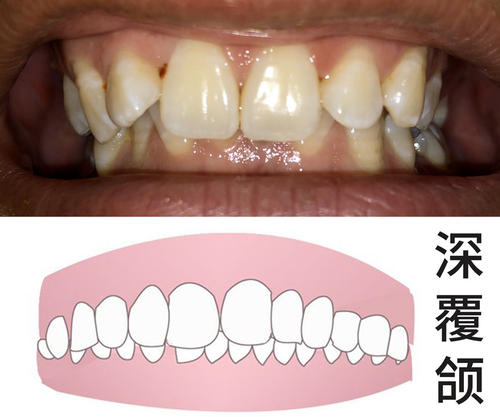 深覆颌-牙齿畸形-牙齿不齐-维港口腔连锁-维港欢笑口腔