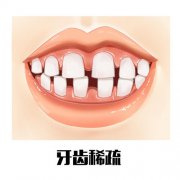 深圳牙齒矯正科普-什麼情況會導致牙縫大呢？
