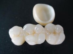 深圳全瓷牙科普——牙冠也有臨時的嗎？