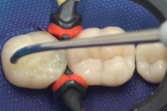 深圳補牙科普—美國3M樹脂和美國科爾樹脂哪個更好呢？