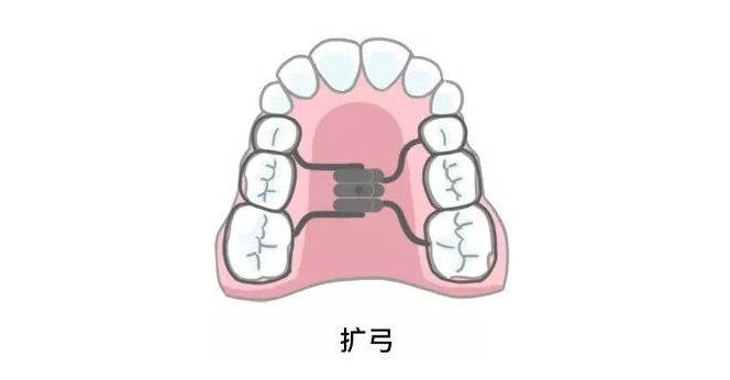 箍牙,深圳箍牙,福田箍牙,擴弓器,維港口腔