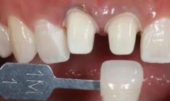 深圳鑲牙-鑲牙之前為什麼要磨小牙齒呢？