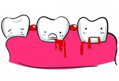深圳牙周治療-牙齦為什麼會流血呢？