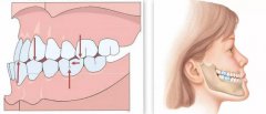 深圳牙齒矯正科普-什麼樣的牙齒需要做牙齒矯正？