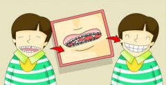 深圳兒童箍牙科普-兒童的哪些不良習慣會導致錯頜畸形？