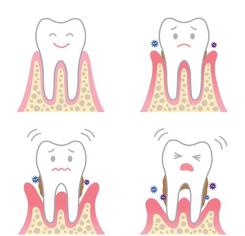 牙齦萎縮-深圳牙科