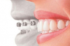 箍牙中牙齒是怎麼移動的呢？