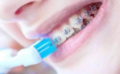 佩戴矯治器後如何刷牙？