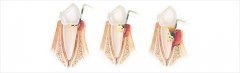 深圳牙周治療科普-牙周炎會引起牙髓炎嗎？