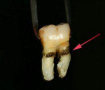 牙周病與吸煙有關系嗎？