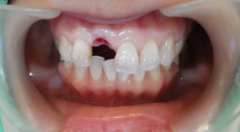 方女士上前牙缺失即刻種植牙修復案例