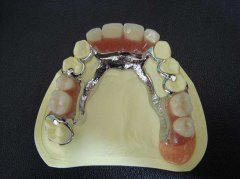深圳鑲牙—拔牙後多長時間鑲牙比較合適？