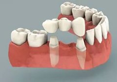 深圳鑲牙—鑲牙的種類有哪些