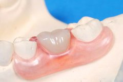深圳假牙-義齒可以用几長時間