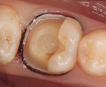 深圳嵌體-牙齒有洞時除了直接補牙，還有其他的方法嗎？