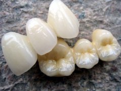 深圳烤瓷牙—什麼樣的牙齒不適宜做烤瓷牙呢？