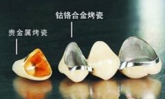 深圳烤瓷牙—金屬烤瓷冠對核磁共振有影響嗎