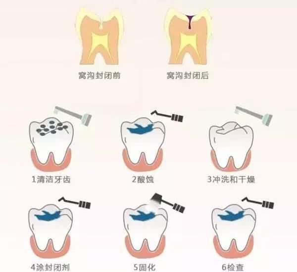 深圳補牙