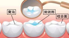 如何預防齲齒的發生