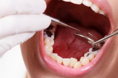 如何預防六齡牙齲壞