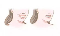 影響臉型發育的錯頜畸形有哪些？
