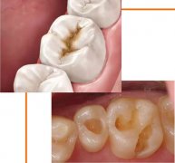 補牙窩洞製備固位形有什麼類型呢？