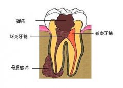 為什麼齲齒會引起牙痛，而且常常夜間發作？