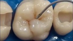 什麼樣的牙可以補？