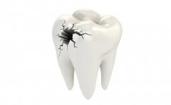 哪些牙最容易患齲病？