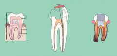 什麼叫牙髓治療呢？