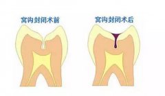 什麼樣的人不適合做窩溝封閉？