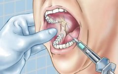拔牙常用的麻醉方法