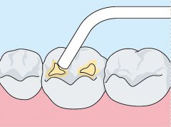 窩溝封閉主要是什麼成分？