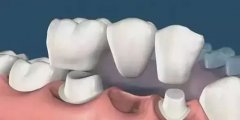 固定義齒有什麼分類呢？