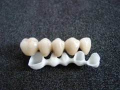 鑲牙前的牙槽骨修整是什麼？