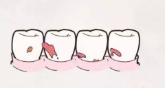 乳牙齲病和根尖周病的治療目的是什麼？