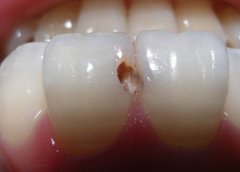 兒童牙齦炎有哪些類型，怎樣治療？