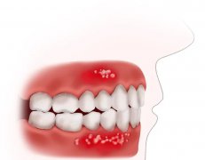 兒童患有牙齦増生應如何治療？