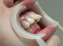 怎樣預防牙頜畸形呢？