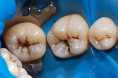 發生齲齒可不可以只吃藥，而不去看牙醫呢？
