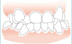 為什麼矯正牙齒有時要拔掉好牙？哪些情況需要拔牙？