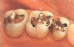 補牙的銀汞合金有毒嗎？