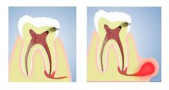 引起根尖周炎的原因有什麼呢？